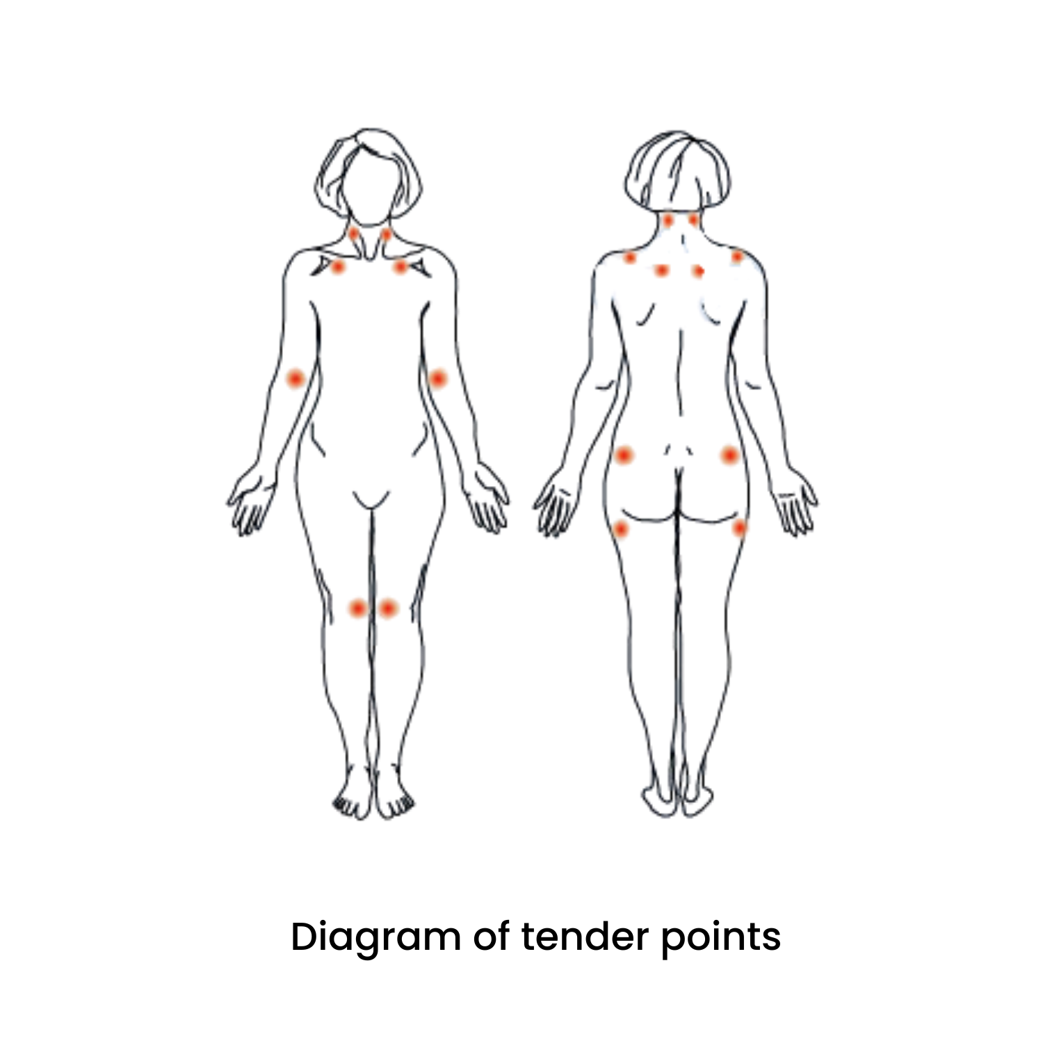 Diagram of tender points for people that are living with fibromyalgia