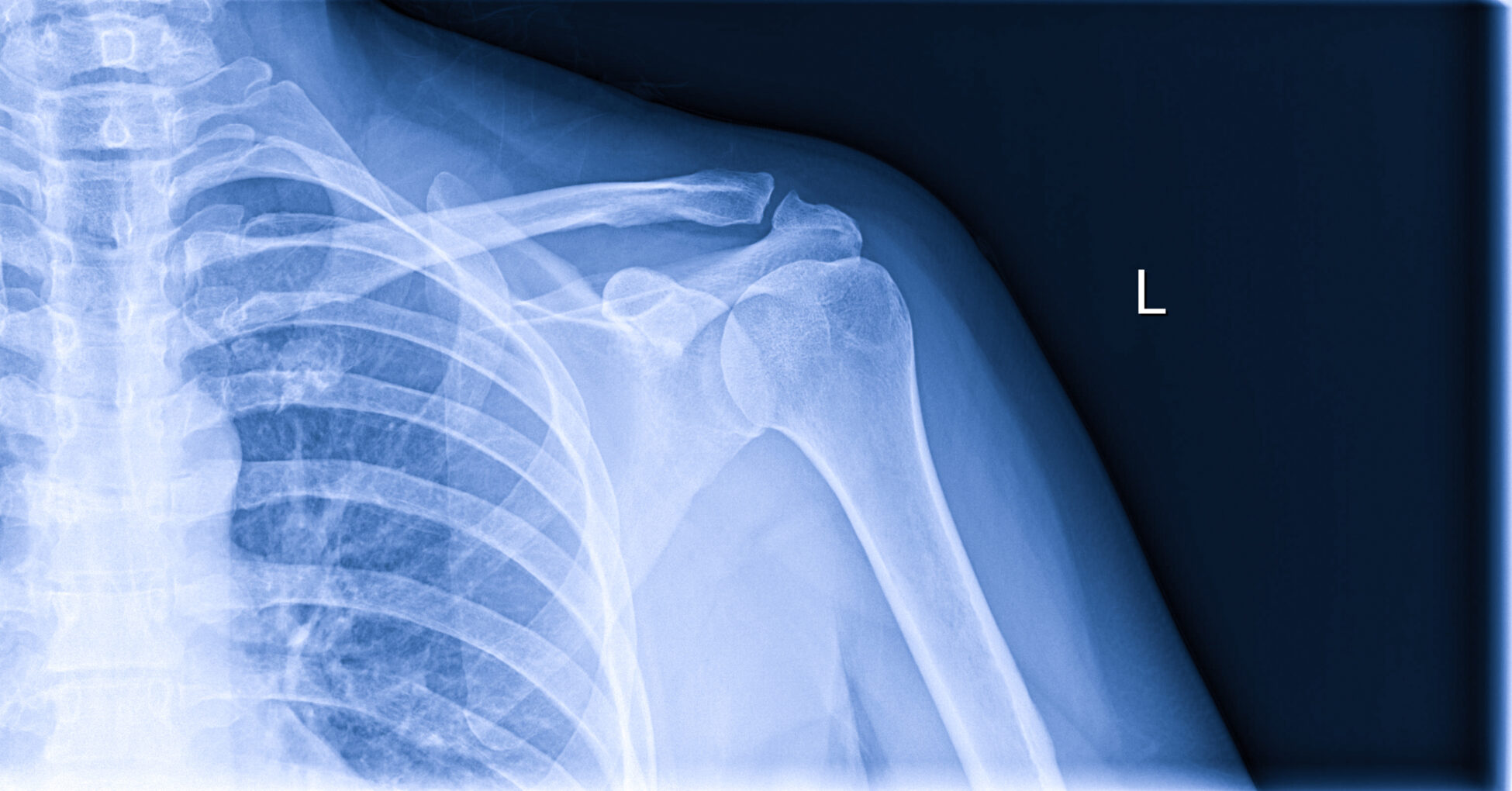 Black and blue X-ray image of broken shoulder